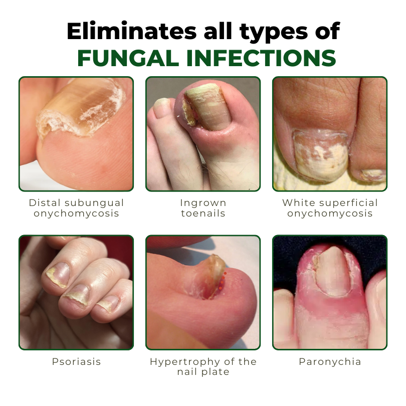Fivfivgo™ NailNurture Bienengift Fungus Behandlungsöl