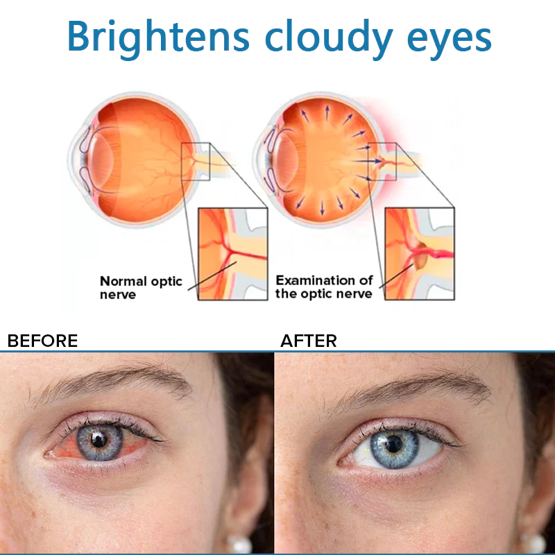 Fivfivgo™ Eye Drops for Vision Problem