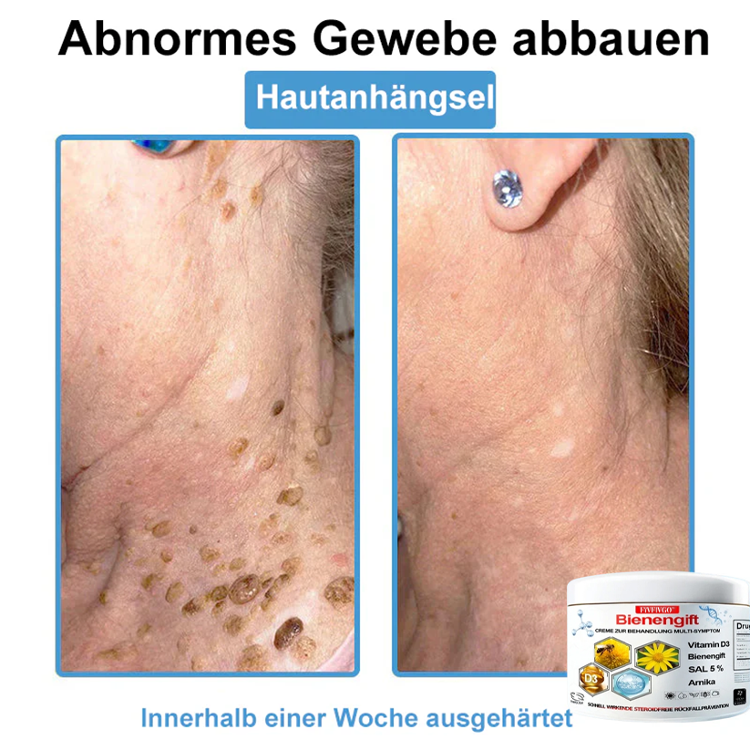 Fivfivgo™ Bienengift Creme Zur Behandlung Multi-symptom