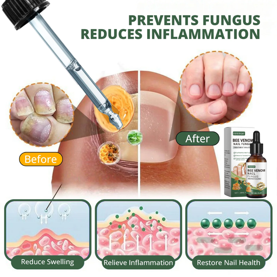 Fivfivgo® Bee Venom Nail Fungus Treatment Solution: Natural Formula for Toenail & Fingernail Health
