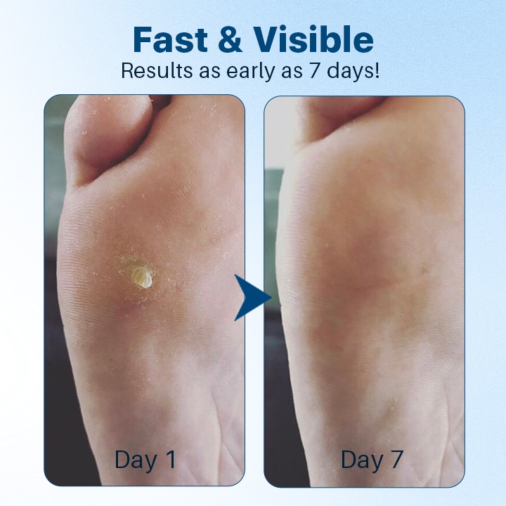 Fivfivgo™ FootGlow Pro-Strength Corn & Callus Remover Gel