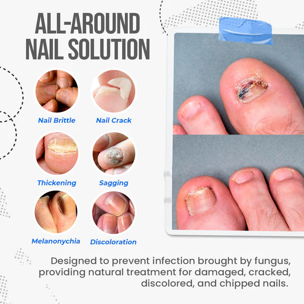 Fivfivgo™ FungusShield Nagelpilz-Behandlungscreme