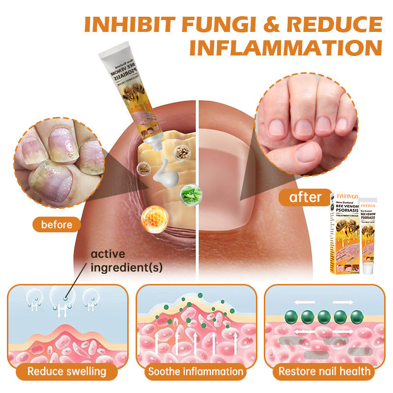 Fivfivgo™ Neuseeland Bienengift Psoriasis Behandlung Creme