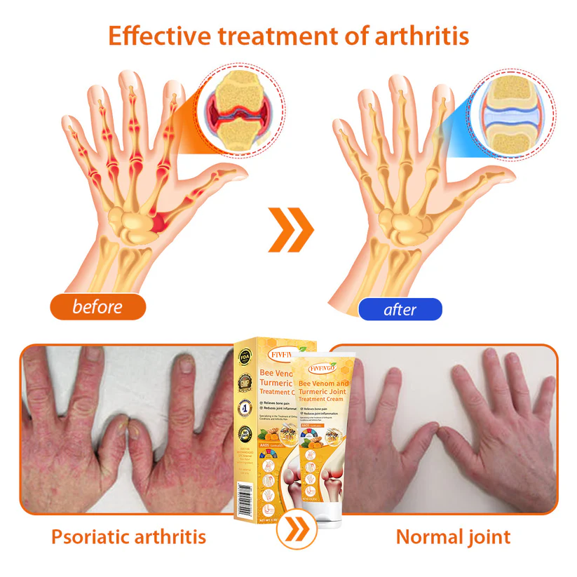 Fivfivgo™ Bee Venom and Turmeric Joint Treatment Cream (Specialized in relieving orthopedic discomfort and arthritis pain)