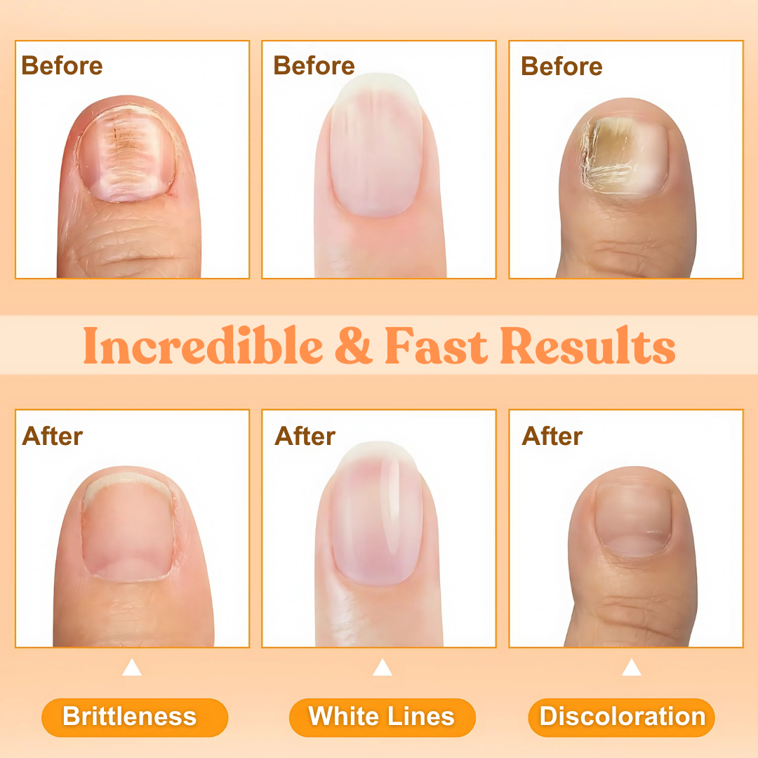 Fivfivgo™ Bee Venom Nail Repair Treatment Spray