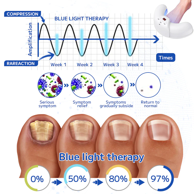Fivfivgo™ Dispositif Laser de Traitement des Ongles Fongiques