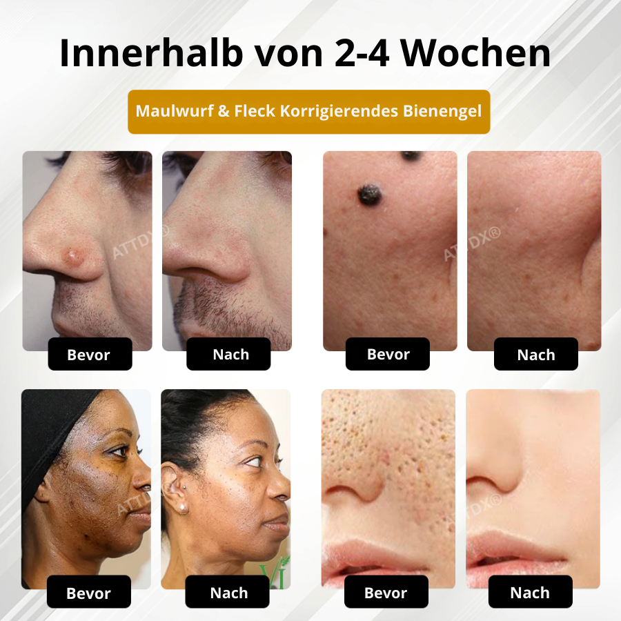 Fivfivgo® Fortschrittliches Maulwurf & Fleck Korrigierendes Bienengel