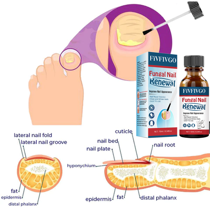 Fivfivgo™ Nail Fungus Treatment Gel