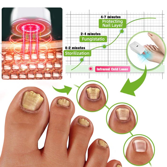 Fivfivgo™ Nagelpilz Laser-Behandlungsgerät