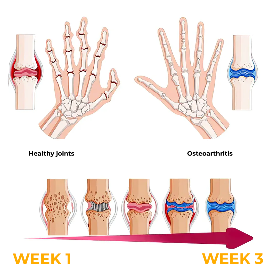 Fivfivgo™ Creme zur Behandlung von rheumatoider Arthritis und Krampfadern