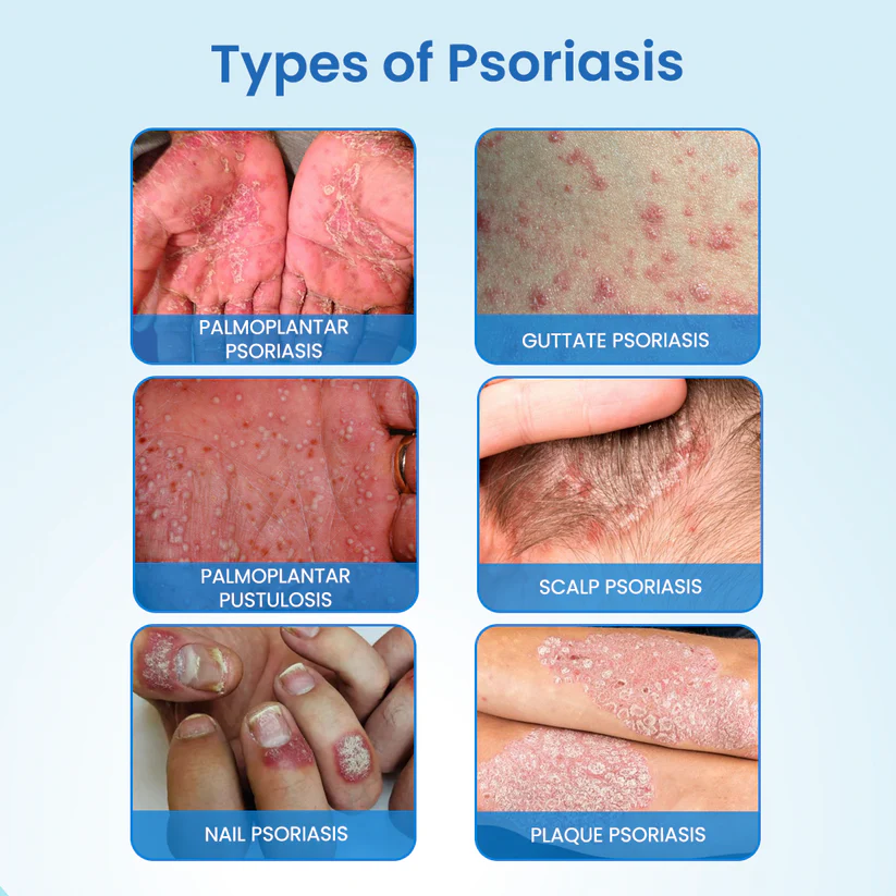 Fivfivgo® MagnesiumHerb Psoriasis Relief Cream