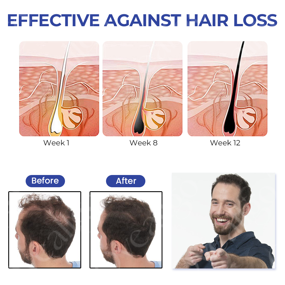 Fivfivgo™ ReVita Haarwachstumsserum - Minoxidil Topische Lösung USP, 5% mit Biotin