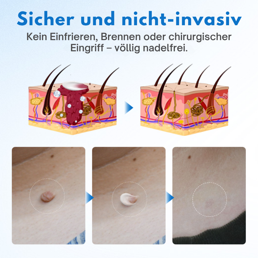 Fivfivgo® TagGone Warzenentfernungscreme