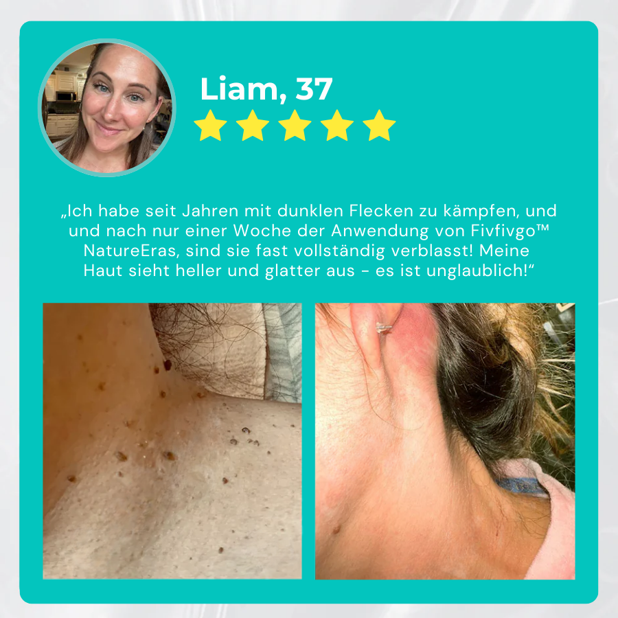 ✅ Offizieller Laden: Fivfivgo™ NatureErase Sofortige Maulwurf- und Fleckencreme