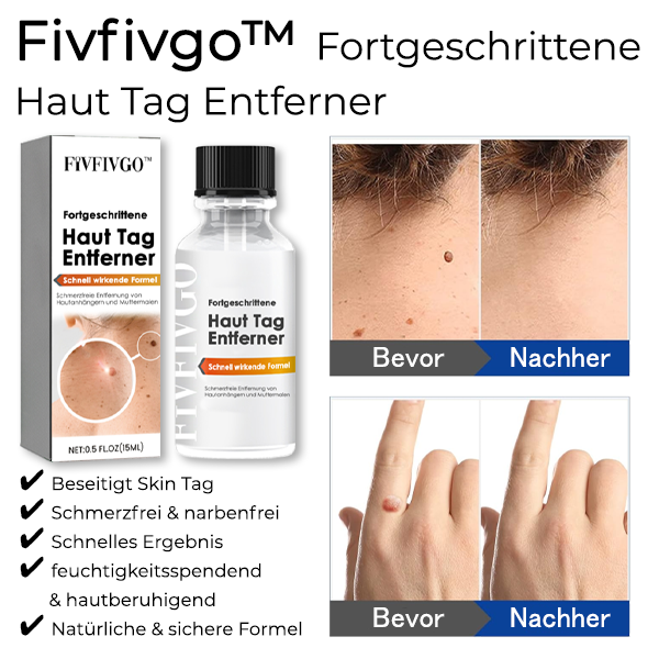 Fivfivgo™ Fortgeschrittene Haut Tag Entferner - Schnell wirkende Formel