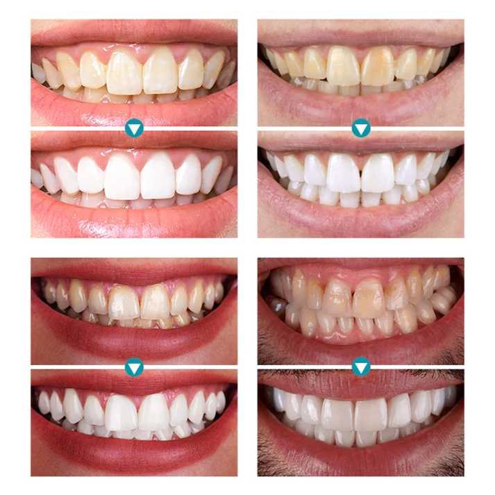 Fivfivgo® Instant Teeth Whitening Paint