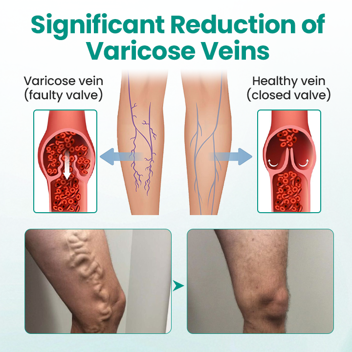 Fivfivgo® LegRenew Varicose Veins Patch