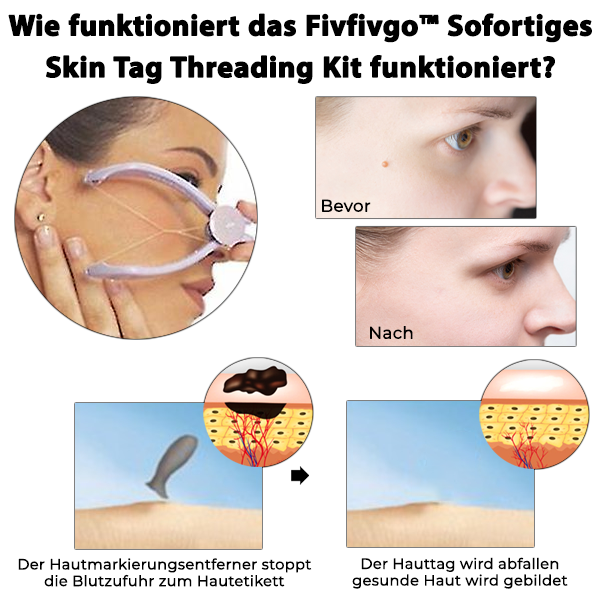 Fivfivgo™ Sofortiges Skin Tag Threading Kit