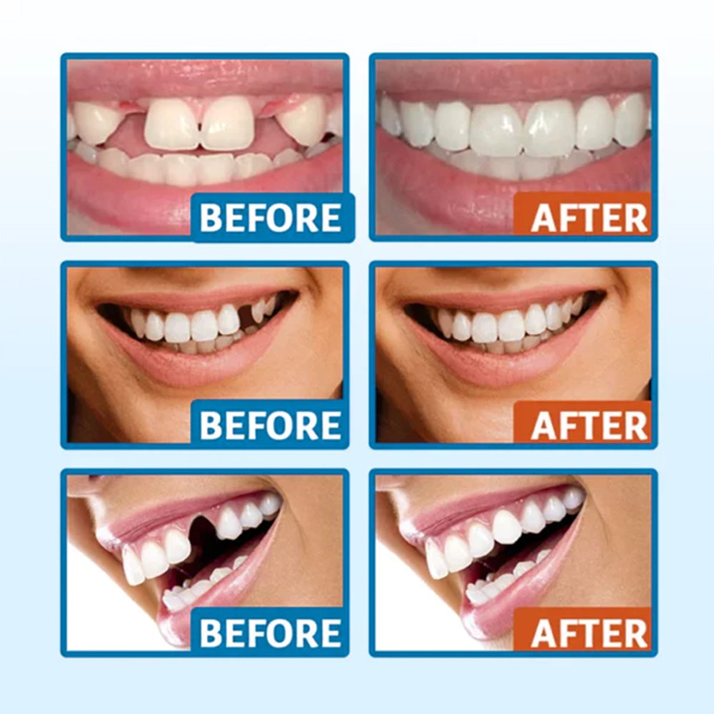 Fivfivgo™ Kit de réparation Glory Smile Sculpteur dentaire temporaire