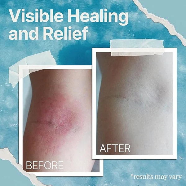 Fivfivgo™ The Ocean Eczema Natural Soothing Cream