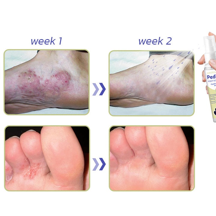 Fivfivgo™ PediSpa Fußpeeling-Spray