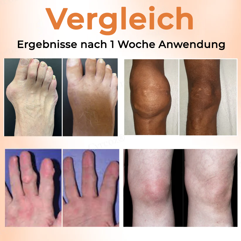 Fivfivgo® Colchicin Nano-Nadeln Pflaster zur Gichtbehandlung