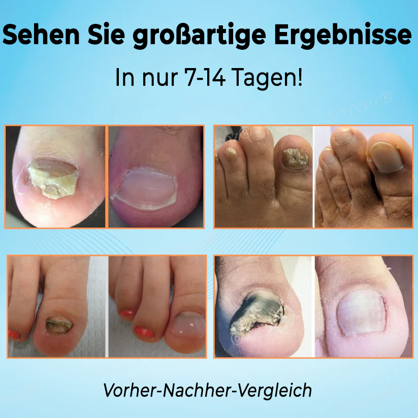 Cvreoz® Nagelstärkungs-Salbe