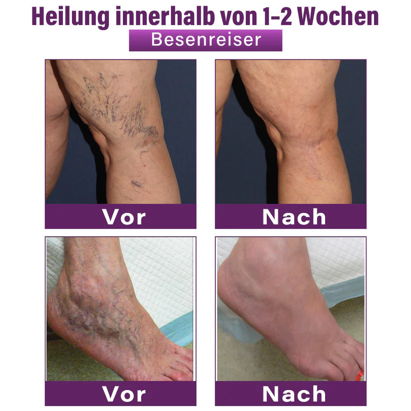 Cvreoz® Polidocanol-Nano-Pflaster gegen Krampfadern👩🏼‍⚕️Empfohlen von der Deutschen Gesellschaft für Phlebologie (DGP)🛡️💪