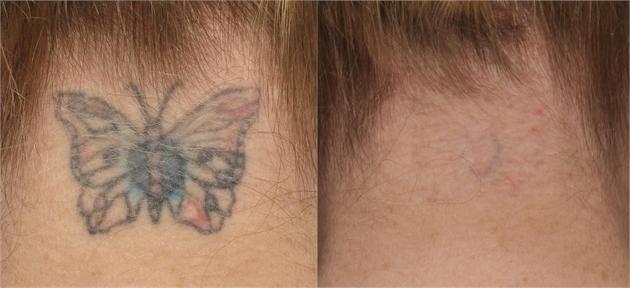 Permanent Tattoo Removal Cream