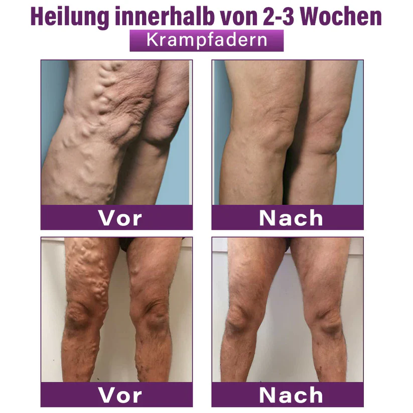 Cvreoz® Polidocanol-Nano-Pflaster gegen Krampfadern👩🏼‍⚕️Empfohlen von der Deutschen Gesellschaft für Phlebologie (DGP)🛡️💪