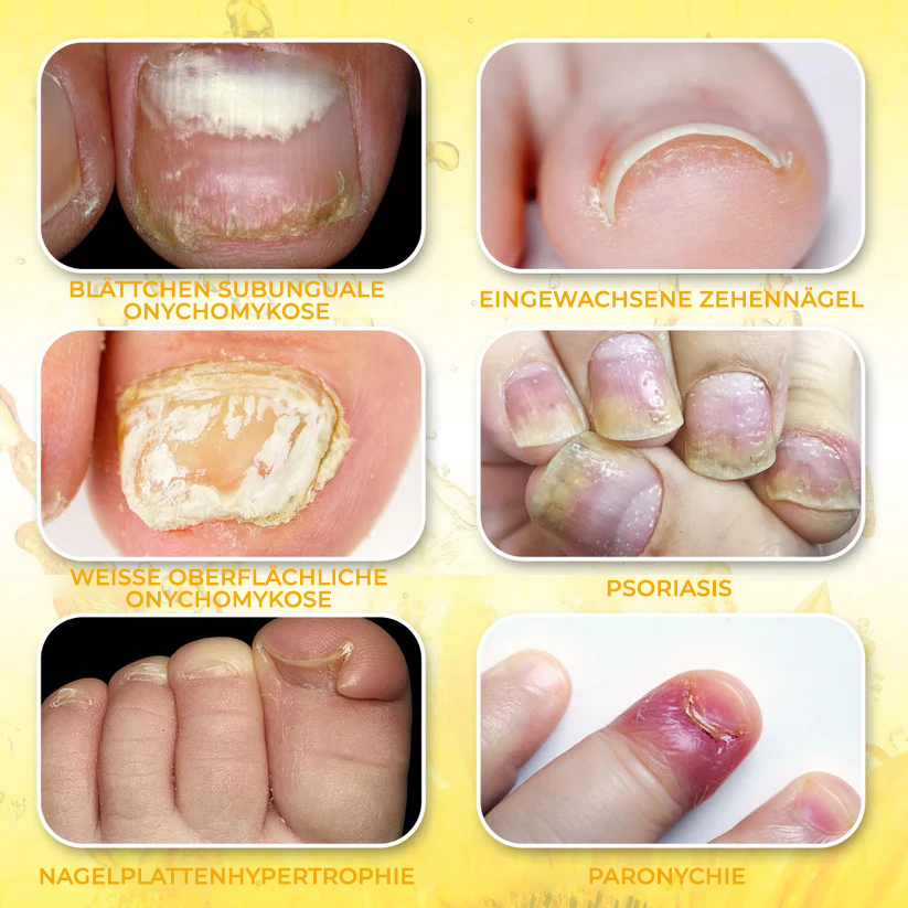 Fivfivgo® ClariNail Bienengift-Pilzlösungstropfen