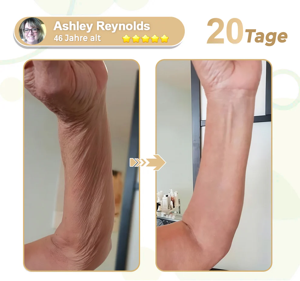 Fivfivgo® Botox-Bienengift-Mikronadelpflaster (schmerzfreie, lang anhaltende Behandlung von hartnäckigen Falten und Hautproblemen)