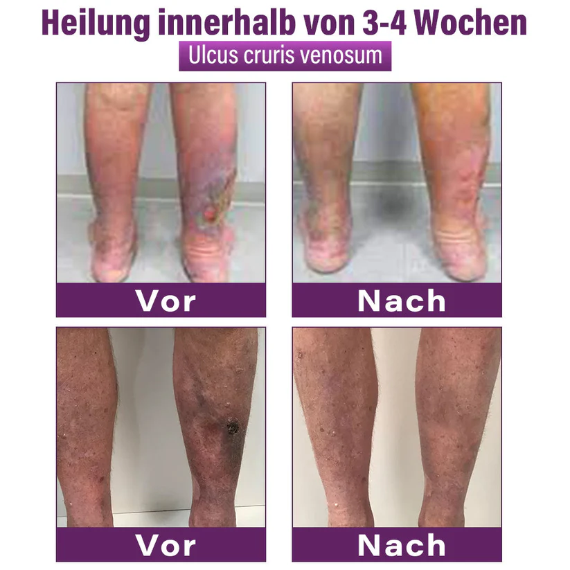 Cvreoz® Polidocanol-Nano-Pflaster gegen Krampfadern👩🏼‍⚕️Empfohlen von der Deutschen Gesellschaft für Phlebologie (DGP)🛡️💪