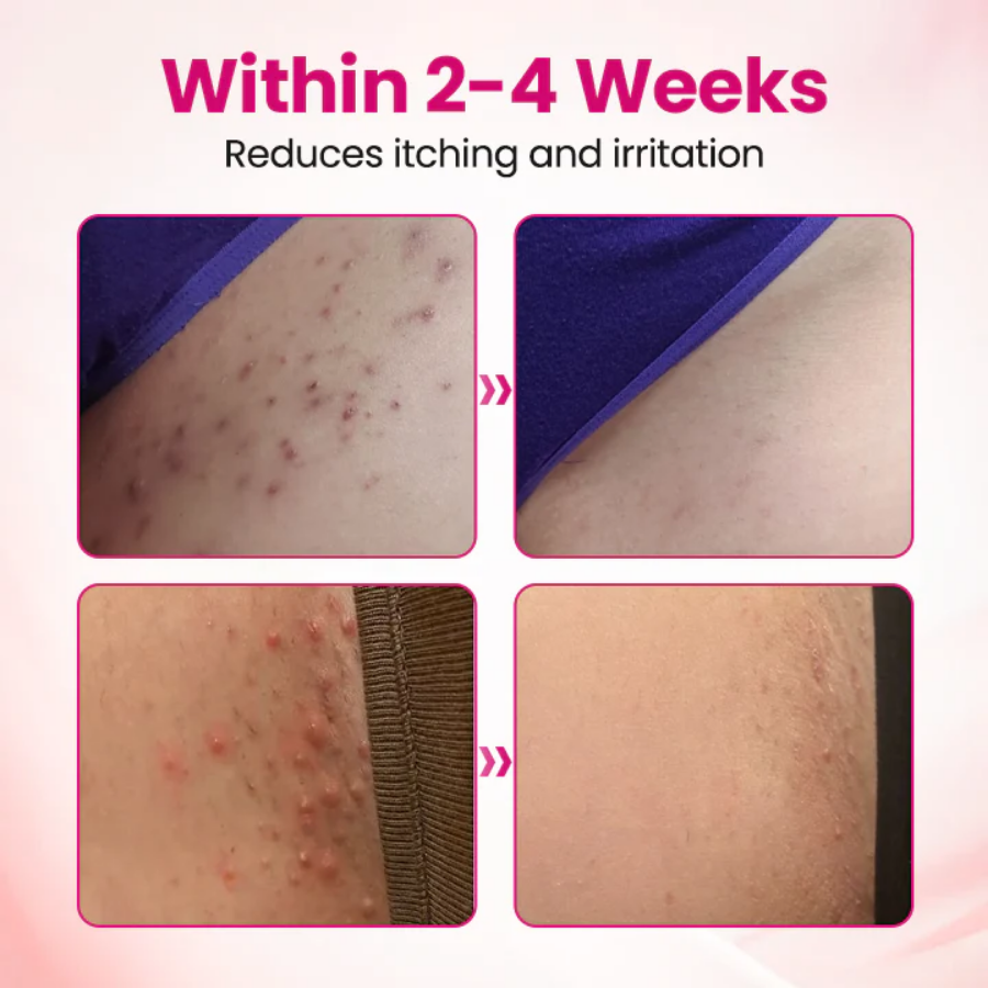 Fivfivgo® IntiDefend Anti-HPV Interferon Gel