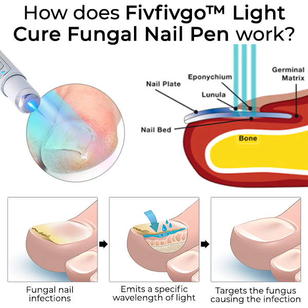 Fivfivgo™ Stylo pour ongles fongiques