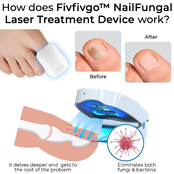 Fivfivgo™ Dispositif de traitement au laser pour les ongles fongiques