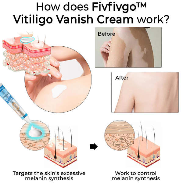 Fivfivgo™ Vitiligo Vanish Crème
