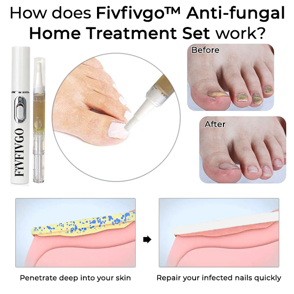 Fivfivgo™ Anti-fungal Home Treatment Set