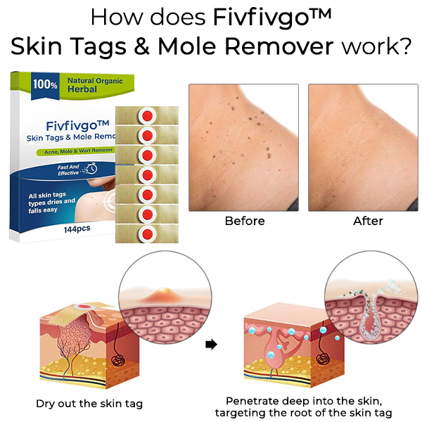 Fivfivgo™ Skin Tags & Mole Remover