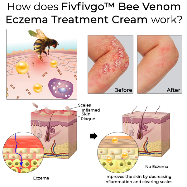 Fivfivgo™ Bee Venom Eczema Treatment Cream