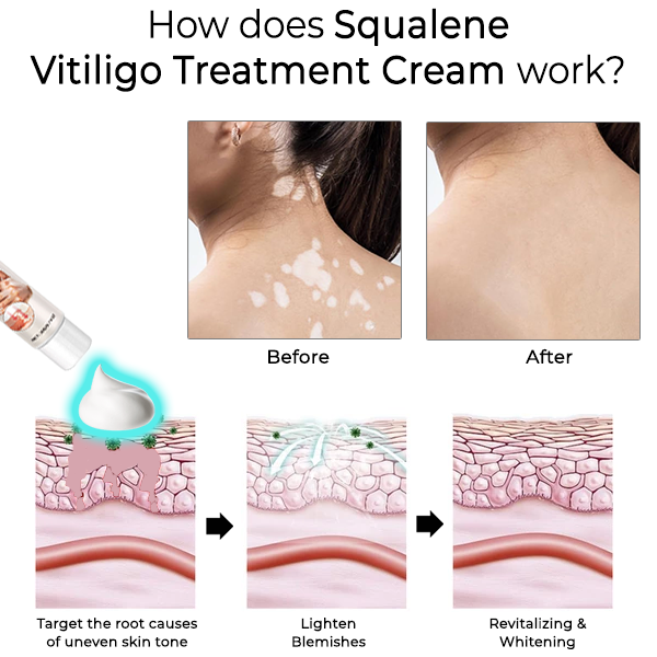 Fivfivgo™ Squalene Vitiligo-Behandlung Creme