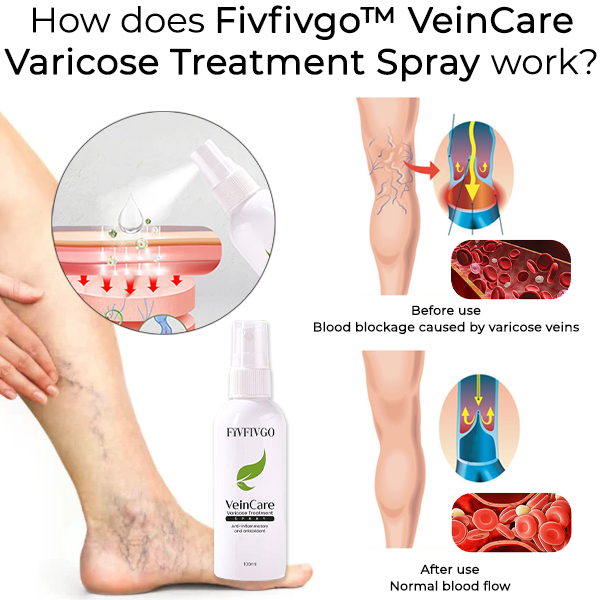 Fivfivgo™ VeinCare Varizen Behandlungsspray