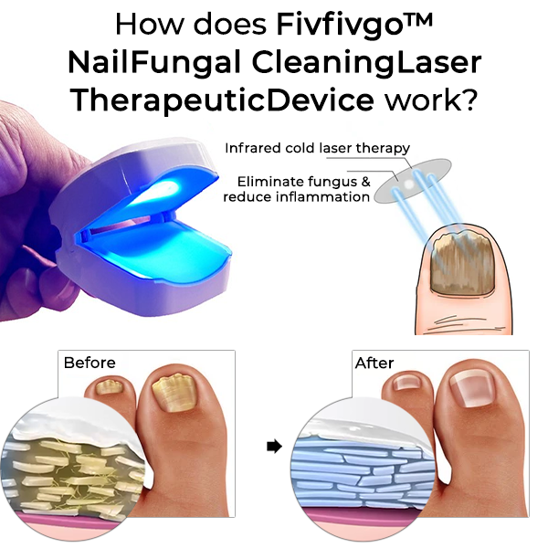 Fivfivgo™ NailFungal CleaningLaser TherapeuticDevice