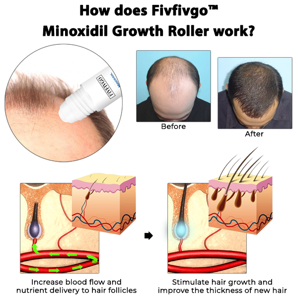 Fivfivgo™ Minoxidil Wachstumsroller