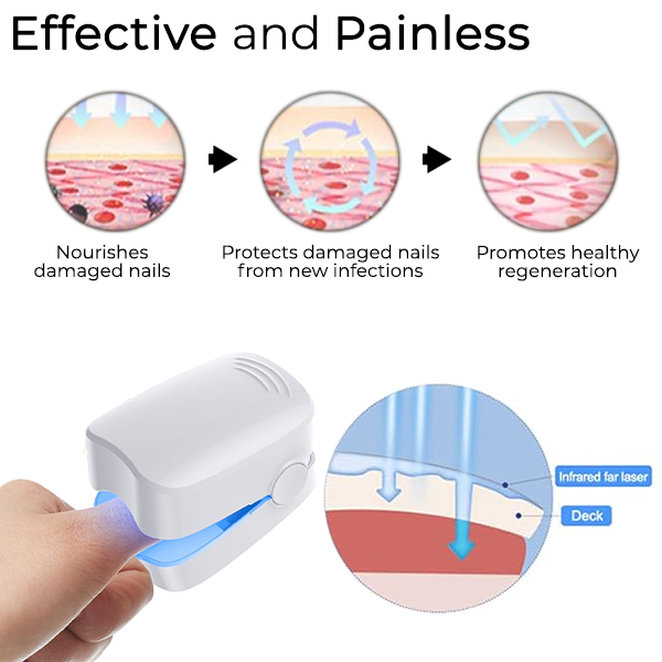 Fivfivgo™ NailFungal Laser Treatment Device
