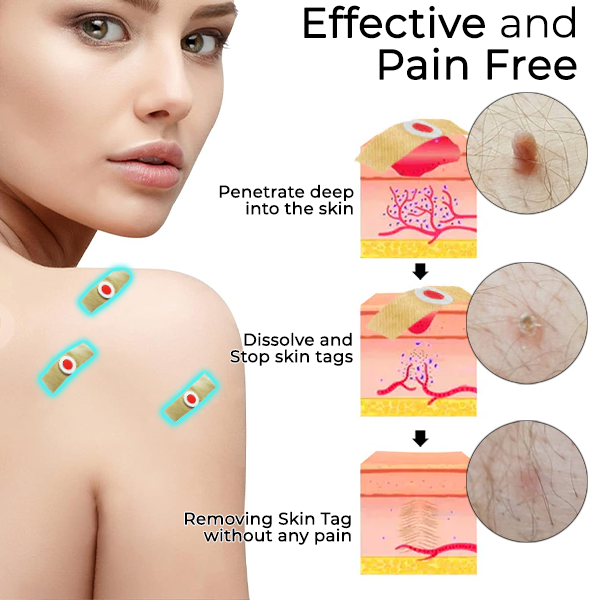 Fivfivgo™ Skin Tags & Mole Remover