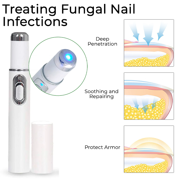 Fivfivgo™ Stylo pour ongles fongiques