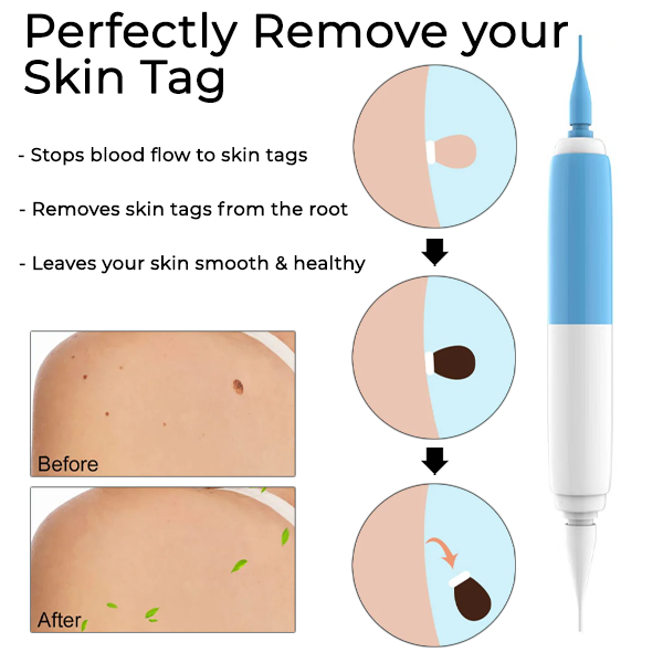 Fivfivgo™ 2-in1 Painless Skin Tag Removal Tool
