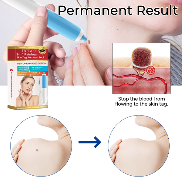 Fivfivgo™ 2-in1 Painless Skin Tag Removal Tool