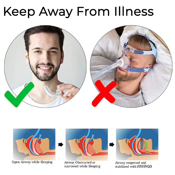 Fivfivgo™ Appareils bucco-dentaires WellSleep pour l’apnée du Sommeil